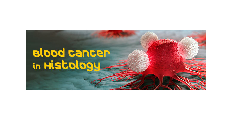 Blood Cancer in Histology, Hematology Markers, IHC | Medical Supply Company